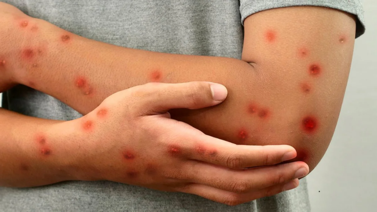 San Juan confirma un caso de Mpox y el país suma 15 contagios en 2026