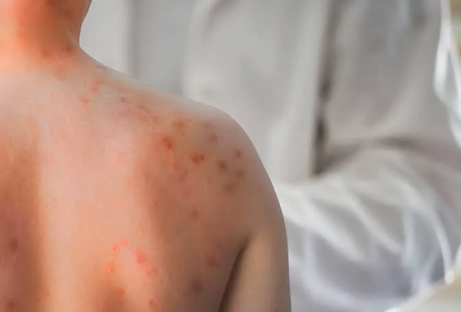 Descartan sarampión en un paciente pediátrico de Caucete